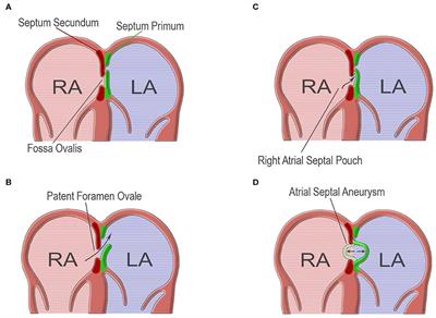 Patent Foramen Ovale in Cryptogenic Ischemic Stroke: Direct Cause, Risk Factor, or Incidental Finding?